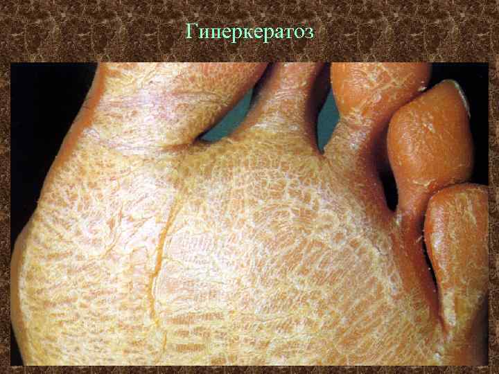 Гиперкератоз 