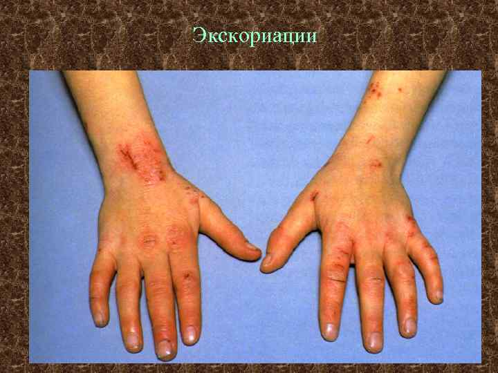 Экскориации 