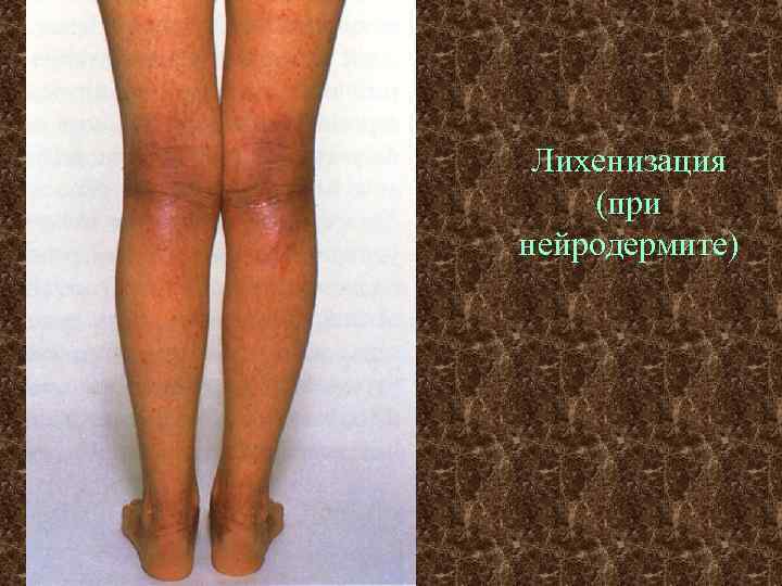 Лихенизация (при нейродермите) 