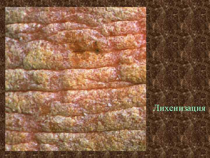 Лихенизация 