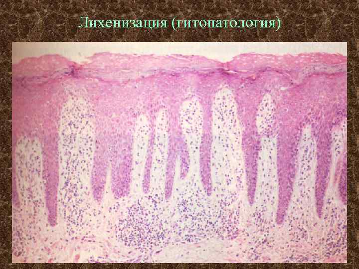 Лихенизация (гитопатология) 
