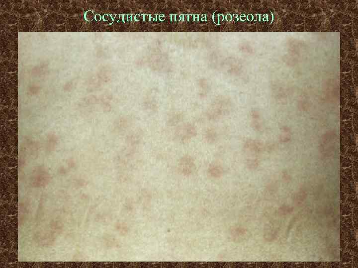 Сосудистые пятна (розеола) 