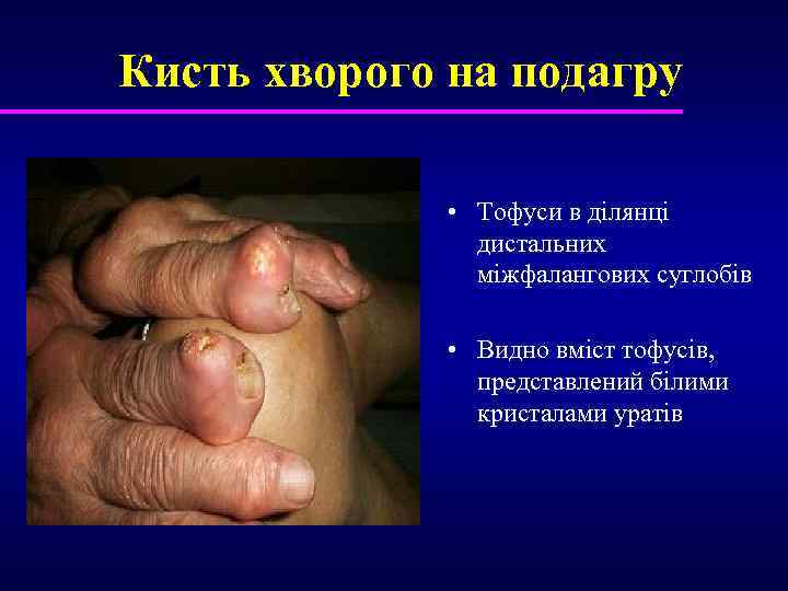 Кисть хворого на подагру • Тофуси в ділянці дистальних міжфалангових суглобів • Видно вміст