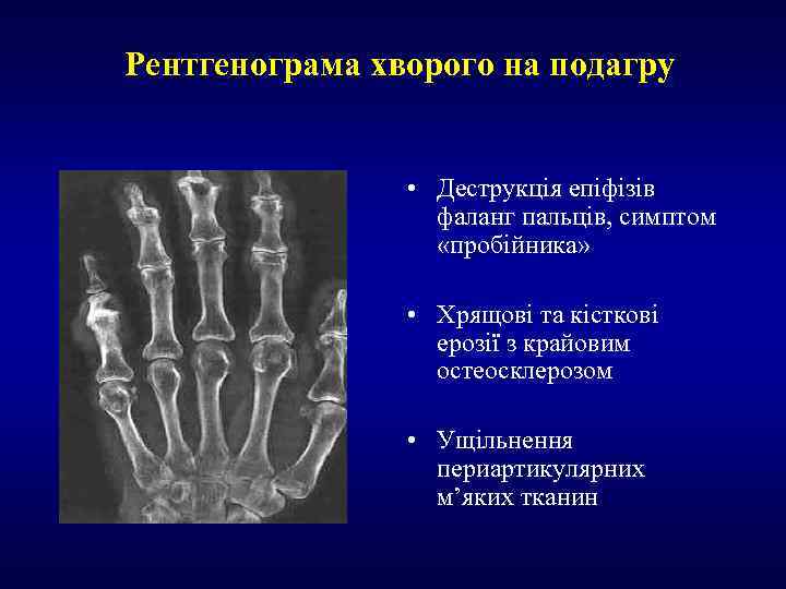Рентгенограма хворого на подагру • Деструкція епіфізів фаланг пальців, симптом «пробійника» • Хрящові та
