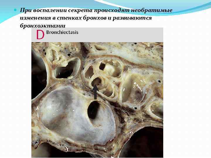  При воспалении секрета происходят необратимые изменения в стенках бронхов и развиваются бронхоэктазии 