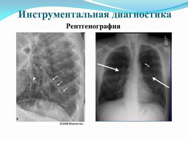 Инструментальная диагностика Рентгенография 