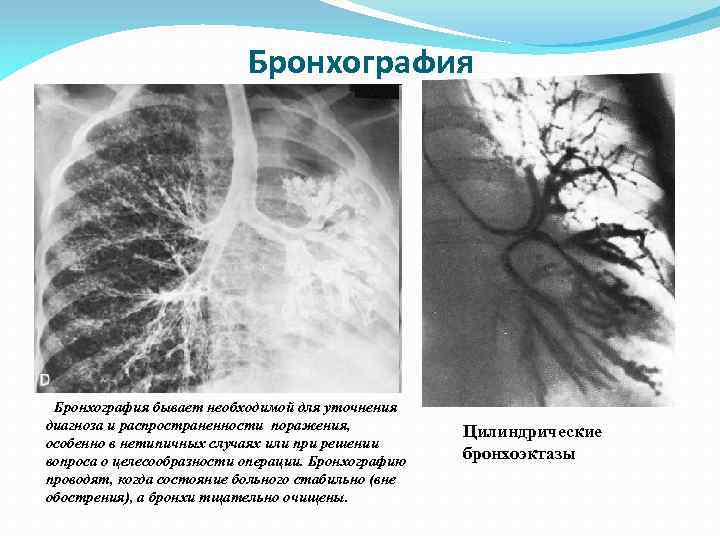 Бронхография бывает необходимой для уточнения диагноза и распространенности поражения, особенно в нетипичных случаях или