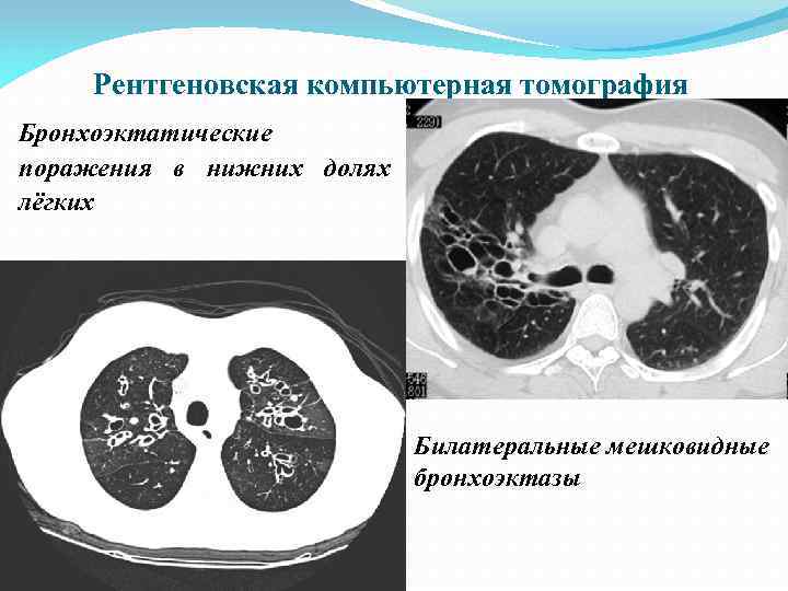 Рентгеновская компьютерная томография Бронхоэктатические поражения в нижних долях лёгких Билатеральные мешковидные бронхоэктазы 