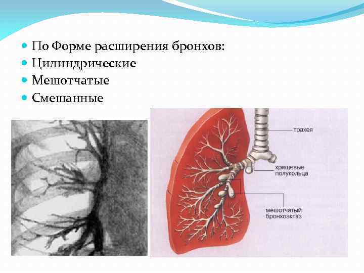  По Форме расширения бронхов: Цилиндрические Мешотчатые Смешанные 