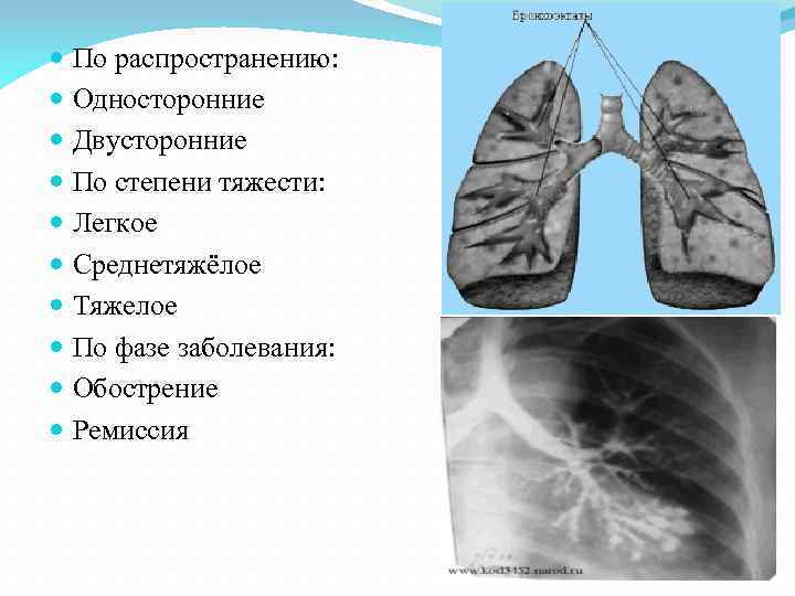  По распространению: Односторонние Двусторонние По степени тяжести: Легкое Среднетяжёлое Тяжелое По фазе заболевания: