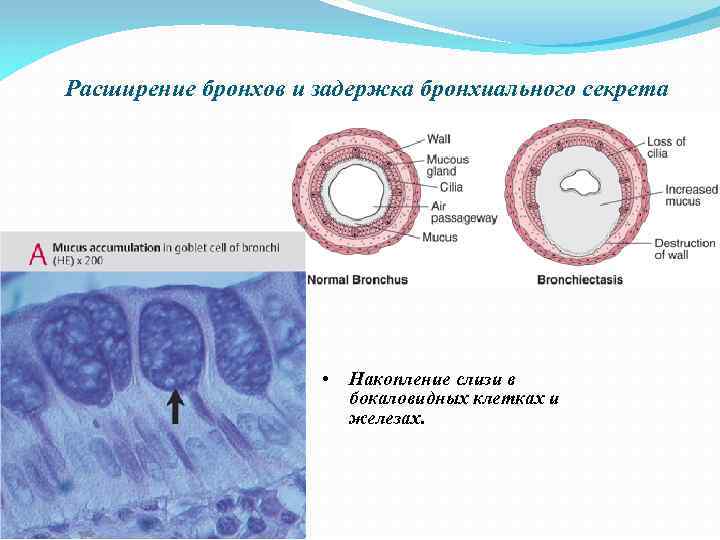 Расширение бронхов и задержка бронхиального секрета • Накопление слизи в бокаловидных клетках и железах.