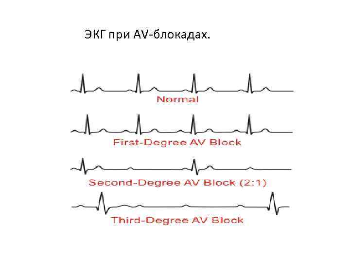 ЭКГ при AV-блокадах. 