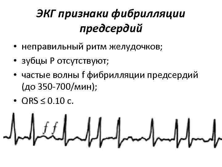 ЭКГ признаки фибрилляции предсердий • неправильный ритм желудочков; • зубцы Р отсутствуют; • частые