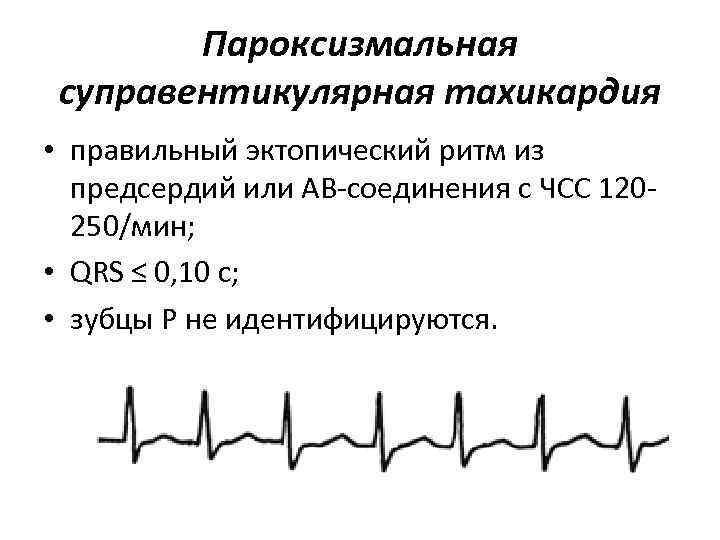 Пароксизмальная суправентикулярная тахикардия • правильный эктопический ритм из предсердий или АВ-соединения с ЧСС 120250/мин;