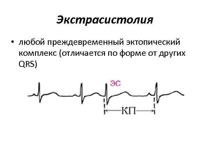 Экстрасистолия • любой преждевременный эктопический комплекс (отличается по форме от других QRS) 