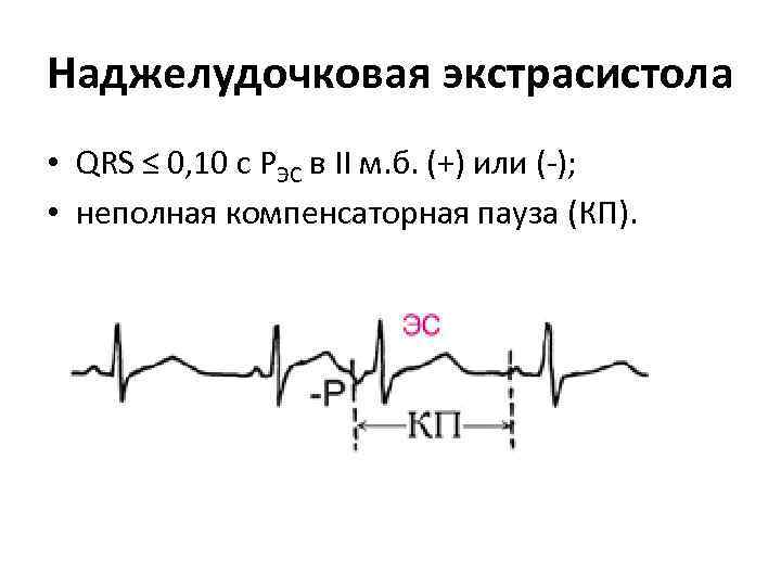 Наджелудочковая экстрасистола • QRS ≤ 0, 10 с РЭС в II м. б. (+)