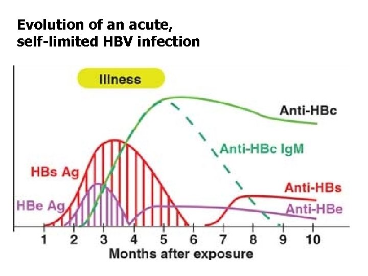 Evolution of an acute, self-limited HBV infection 