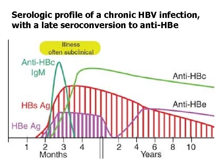 Serologic profile of a chronic HBV infection, with a late seroconversion to anti-HBe 