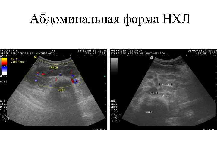 Абдоминальная форма НХЛ 