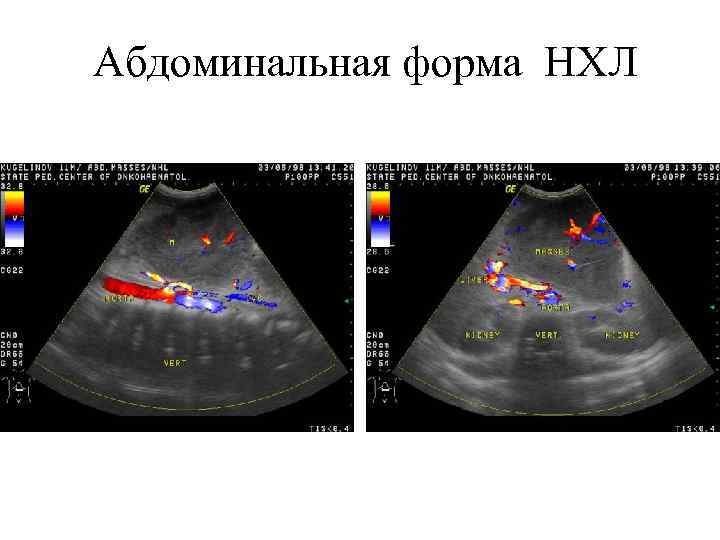 Абдоминальная форма НХЛ 