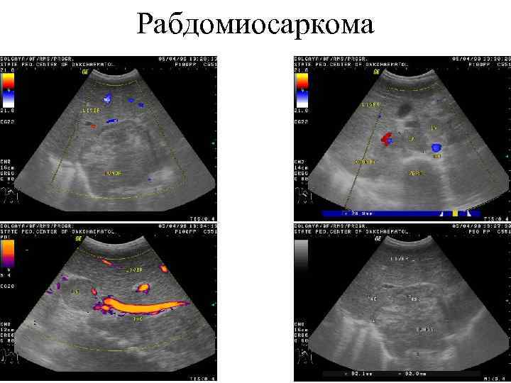 Рабдомиосаркома 