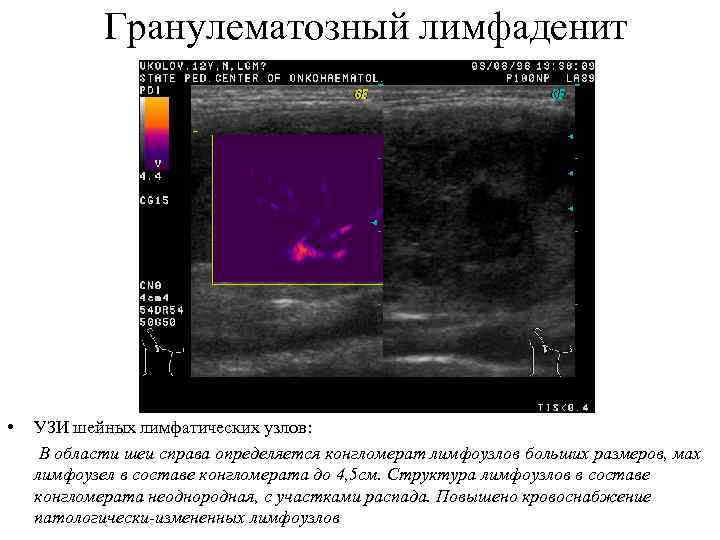 Гранулематозный лимфаденит • УЗИ шейных лимфатических узлов: В области шеи справа определяется конгломерат лимфоузлов