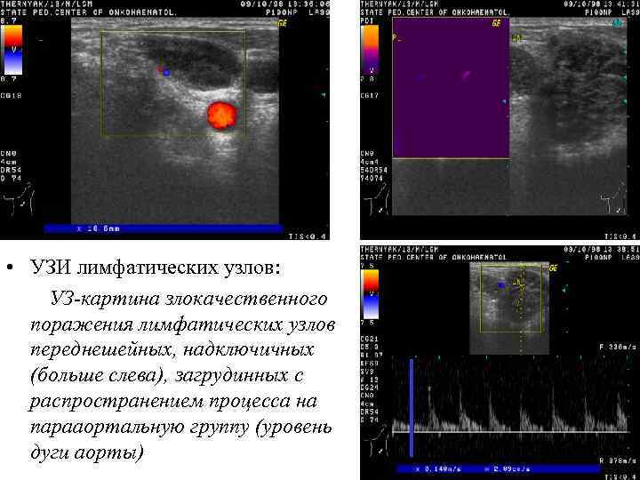  • УЗИ лимфатических узлов: УЗ-картина злокачественного поражения лимфатических узлов переднешейных, надключичных (больше слева),