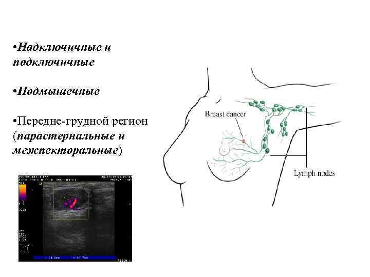  • Надключичные и подключичные • Подмышечные • Передне-грудной регион (парастернальные и межпекторальные) 