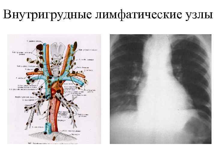 Внутригрудные лимфатические узлы 