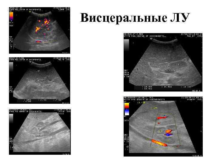 Висцеральные ЛУ 