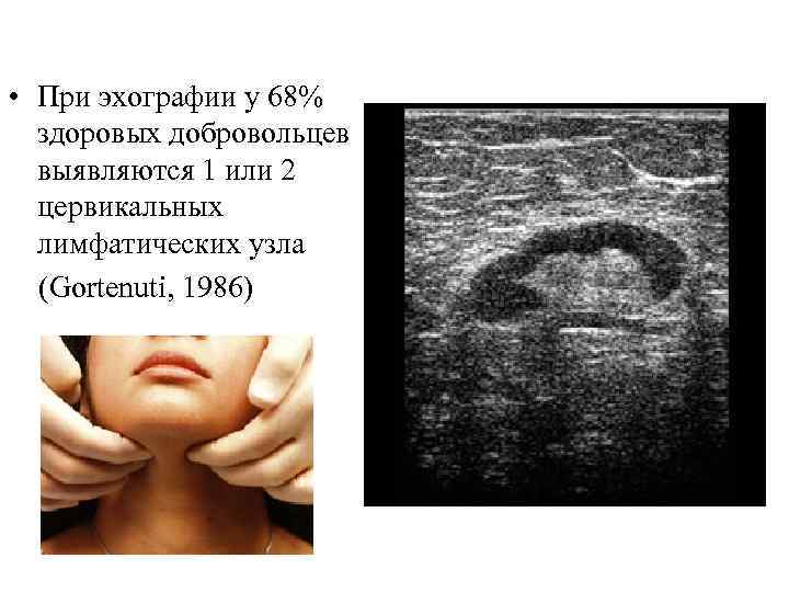  • При эхографии у 68% здоровых добровольцев выявляются 1 или 2 цервикальных лимфатических