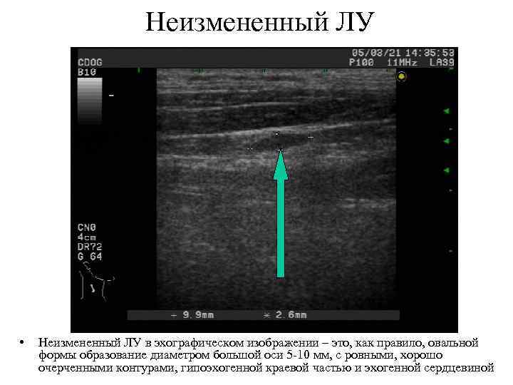 Неизмененный ЛУ • Неизмененный ЛУ в эхографическом изображении – это, как правило, овальной формы