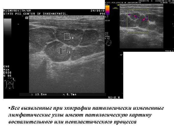  • Все выявленные при эхографии патологически измененные лимфатические узлы имеют патологическую картину воспалительного
