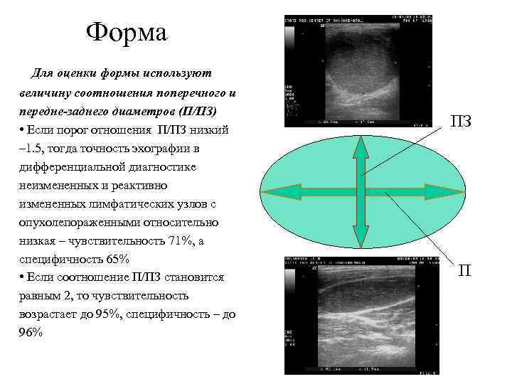 Форма Для оценки формы используют величину соотношения поперечного и передне-заднего диаметров (П/ПЗ) • Если