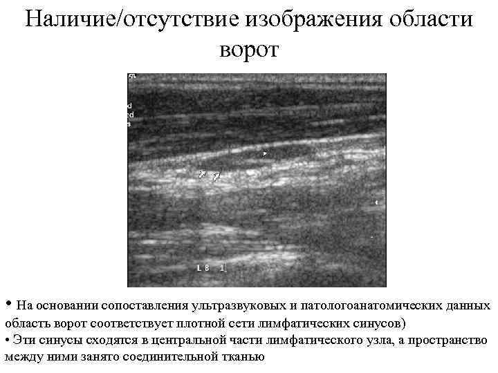 Наличие/отсутствие изображения области ворот • На основании сопоставления ультразвуковых и патологоанатомических данных область ворот