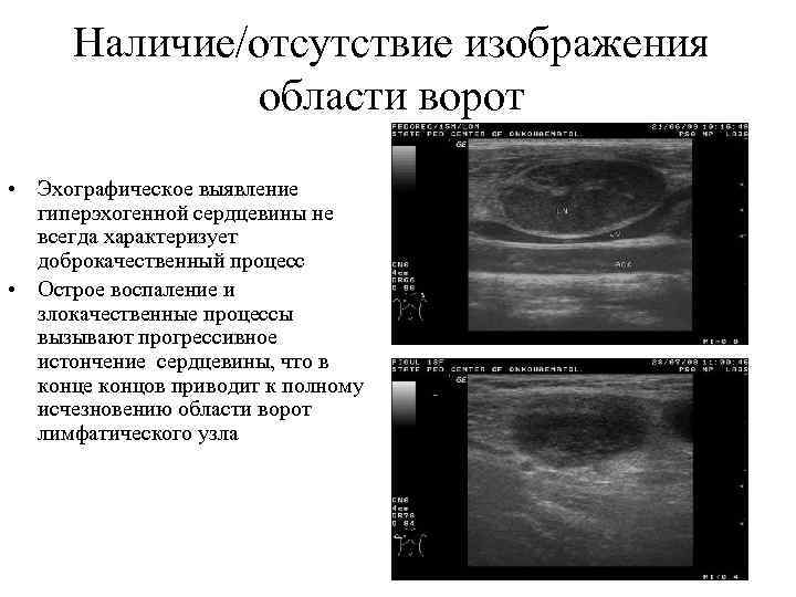 Наличие/отсутствие изображения области ворот • Эхографическое выявление гиперэхогенной сердцевины не всегда характеризует доброкачественный процесс