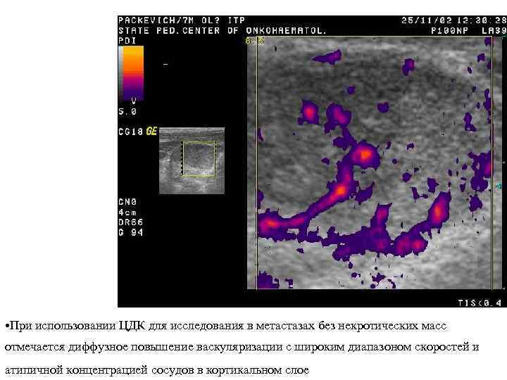  • При использовании ЦДК для исследования в метастазах без некротических масс отмечается диффузное