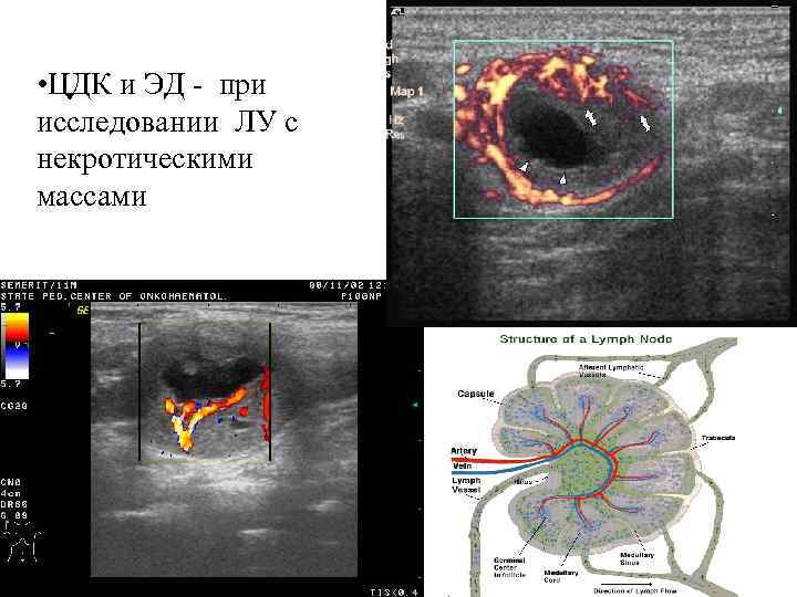  • ЦДК и ЭД - при исследовании ЛУ с некротическими массами 