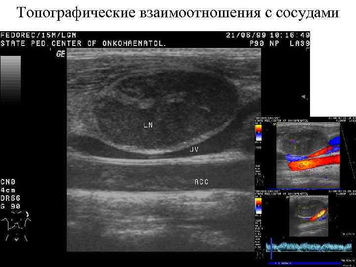 Топографические взаимоотношения с сосудами 