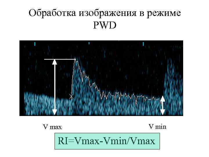 Обработка изображения в режиме PWD V max V min RI=Vmax-Vmin/Vmax 