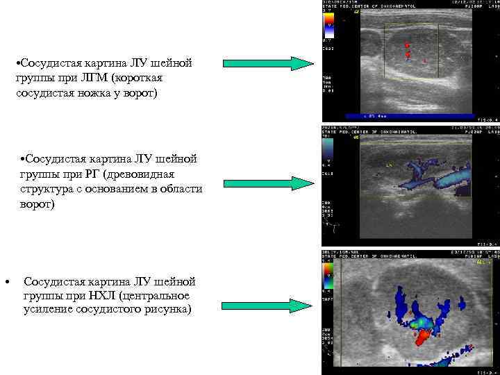  • Сосудистая картина ЛУ шейной группы при ЛГМ (короткая сосудистая ножка у ворот)