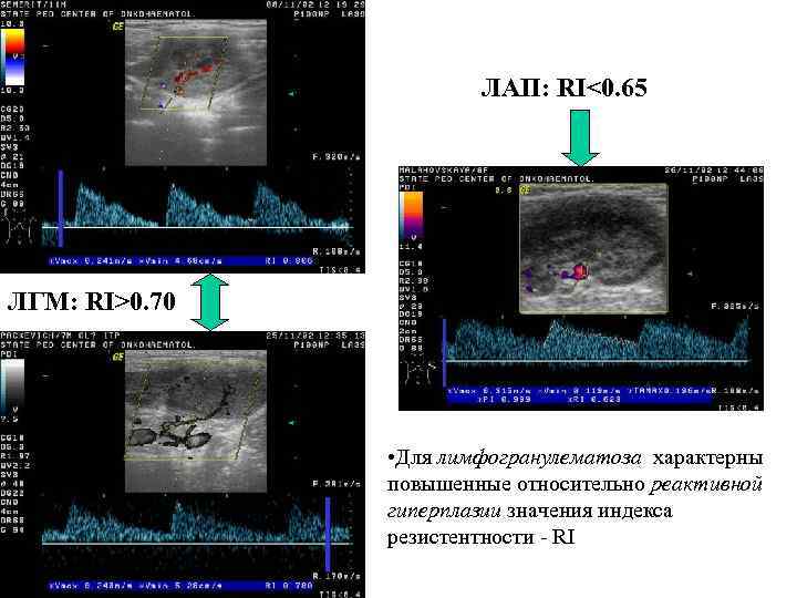 ЛАП: RI<0. 65 ЛГМ: RI>0. 70 • Для лимфогранулематоза характерны повышенные относительно реактивной гиперплазии