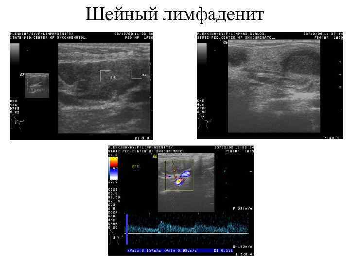 Шейный лимфаденит 