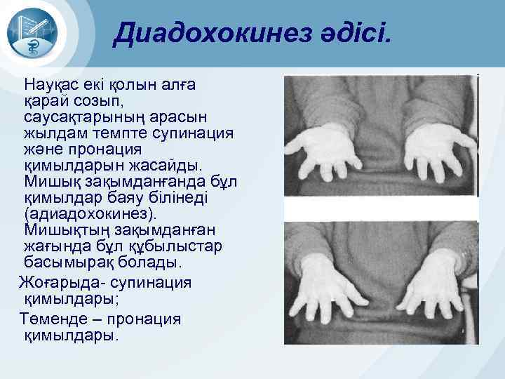 Диадохокинез әдісі. Науқас екі қолын алға қарай созып, саусақтарының арасын жылдам темпте супинация және