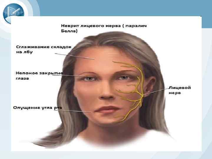 Центральный парез лицевого нерва. Неврит лицевого нерва проявляется.