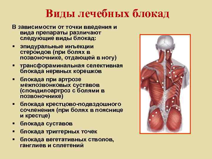 Виды лечебных блокад В зависимости от точки введения и вида препараты различают следующие виды