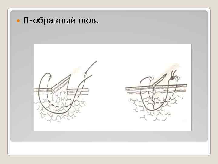 П образный шов в хирургии