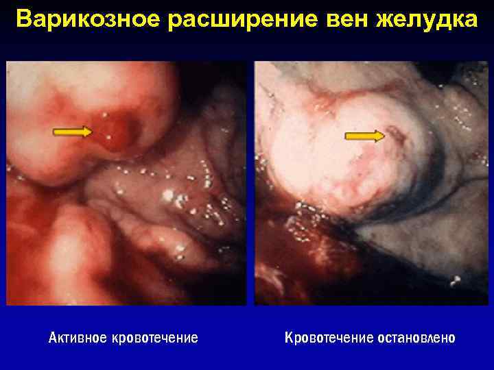 Варикозное расширение вен желудка Активное кровотечение Кровотечение остановлено 