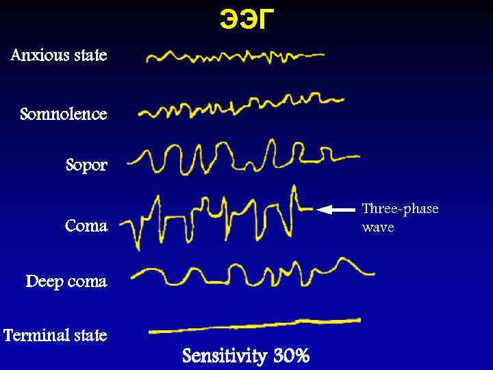 ЭЭГ Anxious state Somnolence Sopor Three-phase wave Coma Deep coma Terminal state Sensitivity 30%