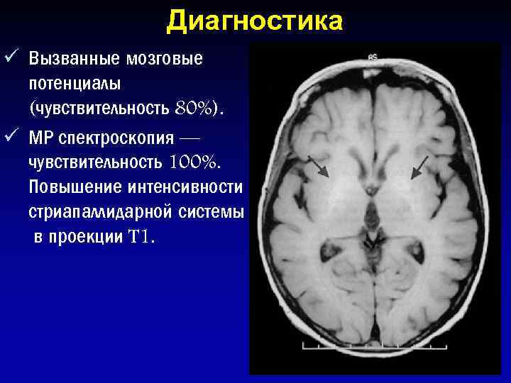 Диагностика ü Вызванные мозговые потенциалы (чувствительность 80%). ü МР спектроскопия — чувствительность 100%. Повышение